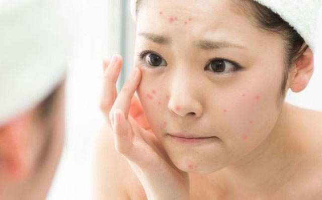 Các bước Skincare cho da dầu mụn